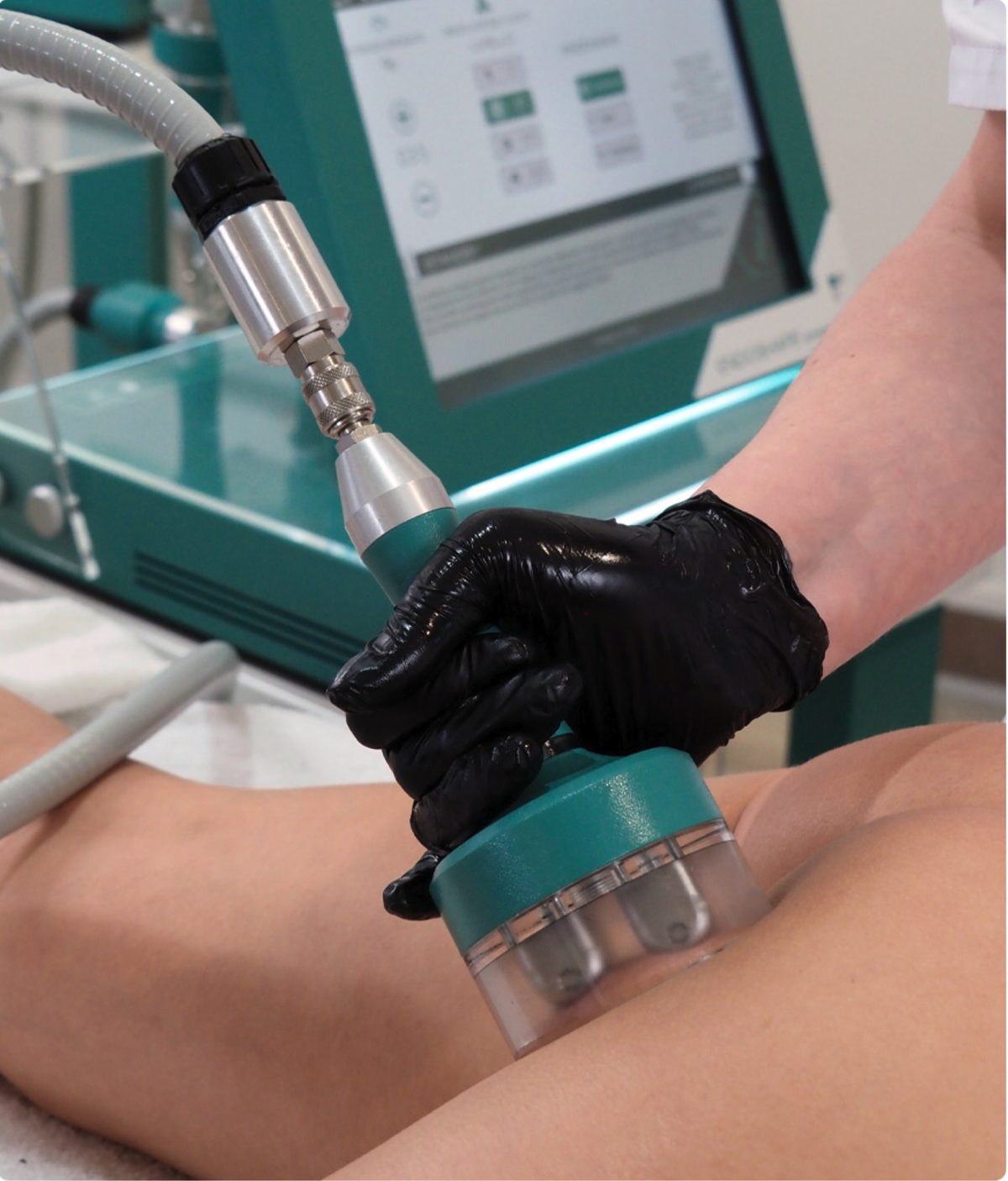 Trattamento Endoshape sulle gambe con manualità mirata